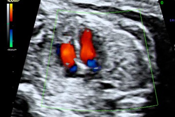 Ecógrafo Doppler Corazón Fetal - Temu Chile