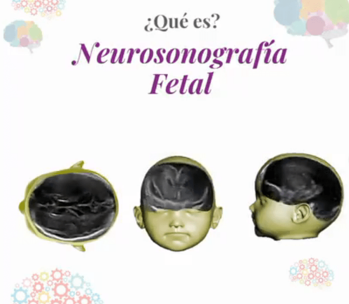 neurosonografía